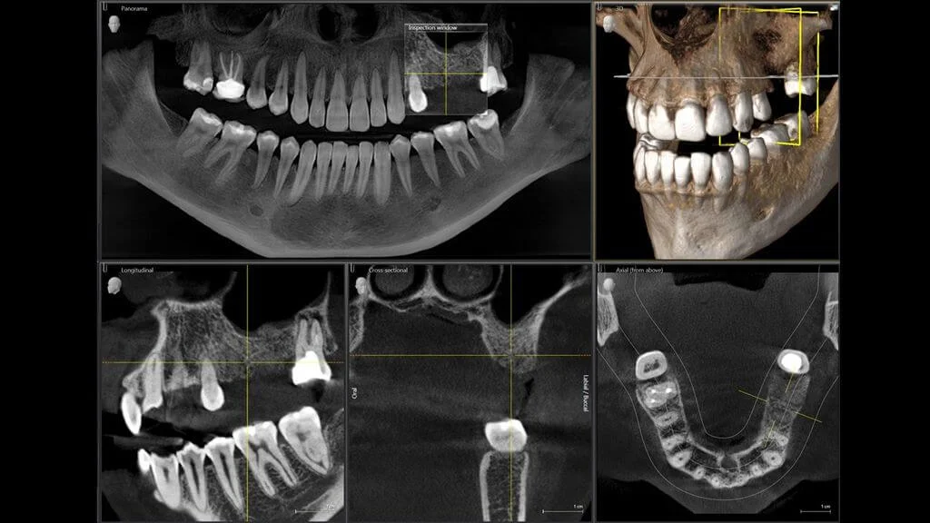 CBCT dentar