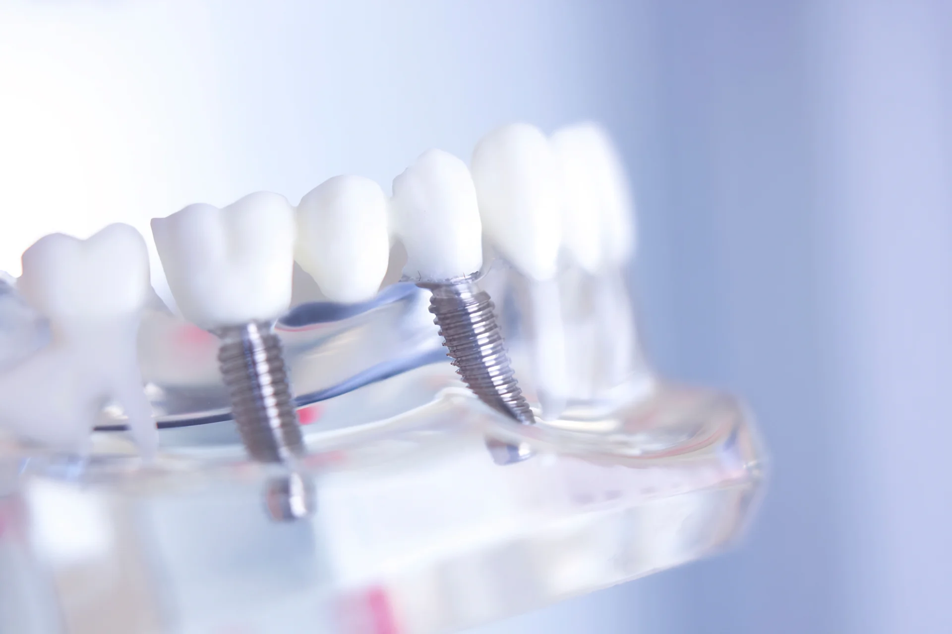 Punte dentară